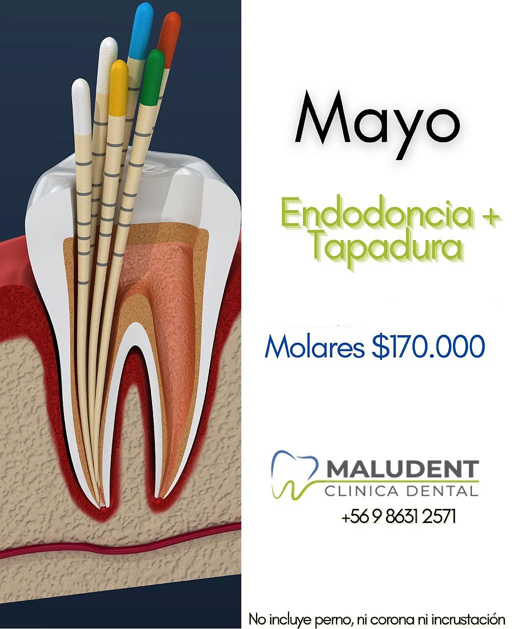 Endodoncia + Tapadura en MOLARES 🦷✨