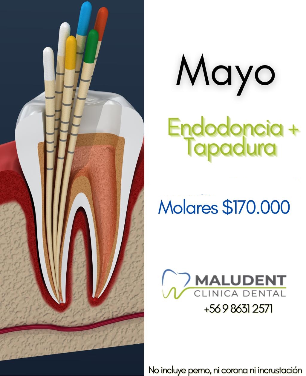 🦷 Este mayo, recupera la salud de tus molares con nuestra promo de Endodoncia + Tapadur...